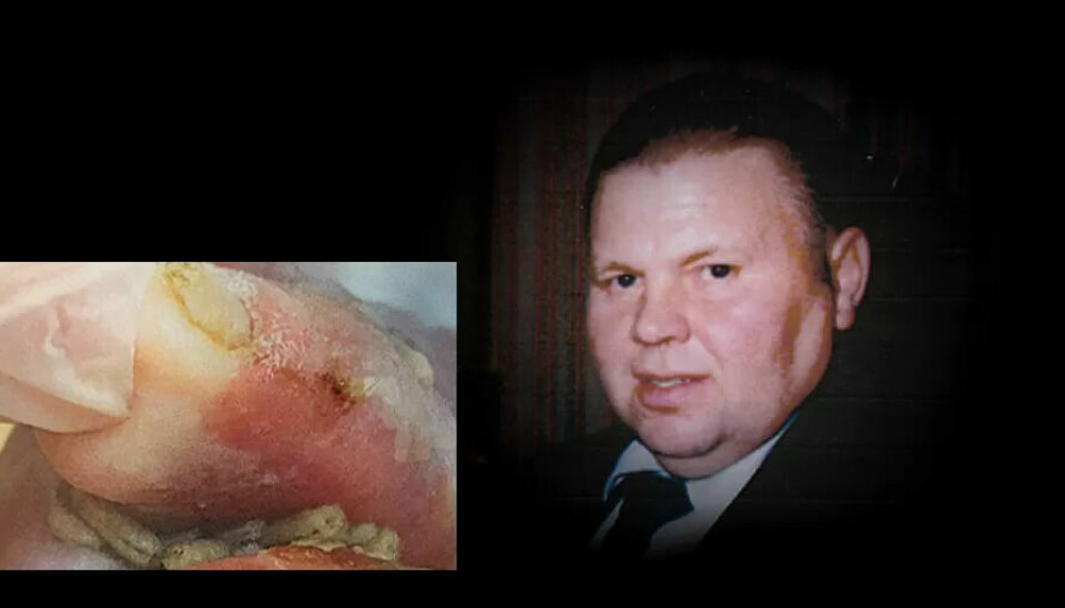 Åge Villi Kristiansen fikk en tragisk avslutning på livet sitt, da levende fluelarver tok bolig i såret hans grunnet for dårlig stell. Fem dager senere døde han av hjertestans. Åge Villi Kristiansen fikk en tragisk avslutning på livet sitt, da levende fluelarver tok bolig i såret hans grunnet for dårlig stell. Fem dager senere døde han av hjertestans.