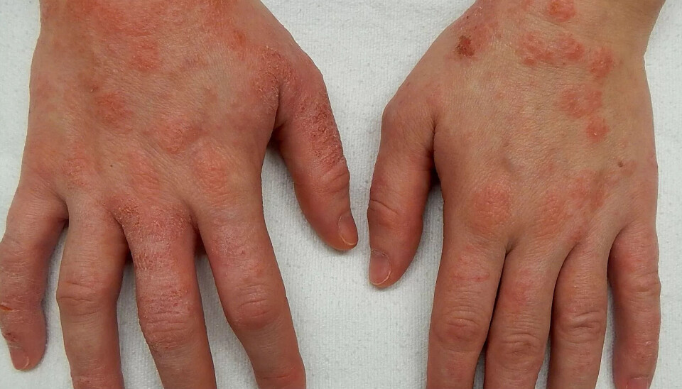 EKSEM: Når hendene blir utsatt for mye belastninger i løpet av en arbeidsdag, vil huden reagere med kløe, rødhet, fortykket og avskallet hud, og med sprekker og sår. EKSEM: Når hendene blir utsatt for mye belastninger i løpet av en arbeidsdag, vil huden reagere med kløe, rødhet, fortykket og avskallet hud, og med sprekker og sår.